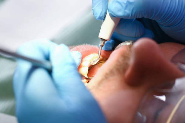 Best Emergency Treatment for Toothache in Glen Ellen, CA