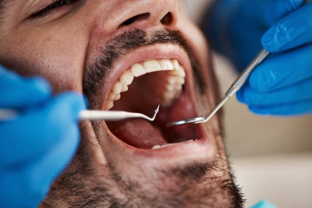 Best Emergency Tooth Extraction in Glen Ellen, CA